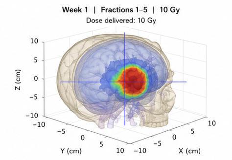 Mathematical Formulation and Computational Implementation of a Fisher-KPP Model for Glioblastoma Invasion under Fractionated Radiotherapy