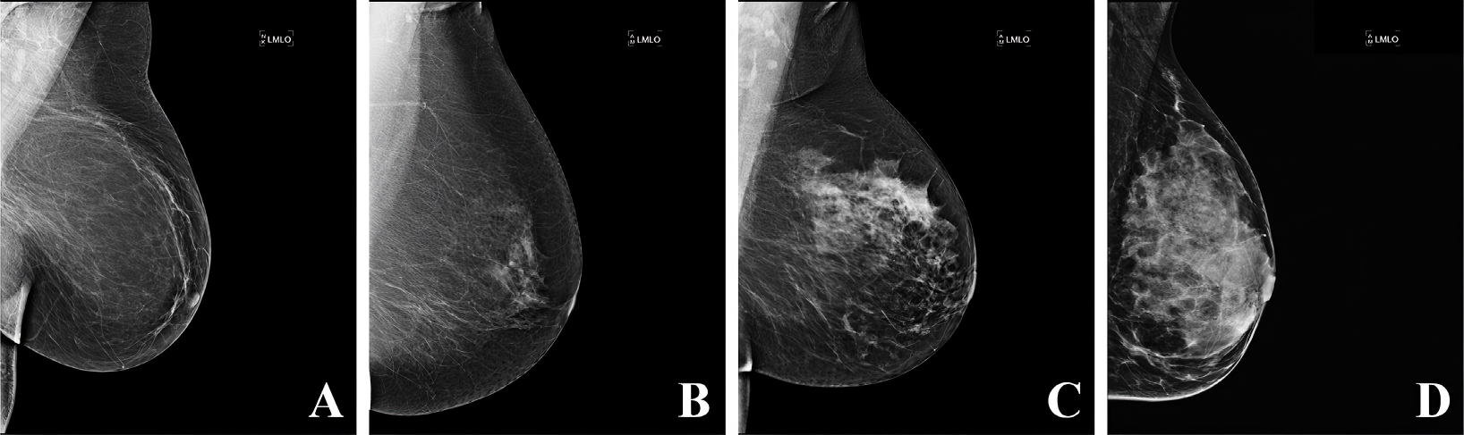 Exploring the Potential of Machine Learning and Deep Learning for Predictive Breast Cancer Analytics
