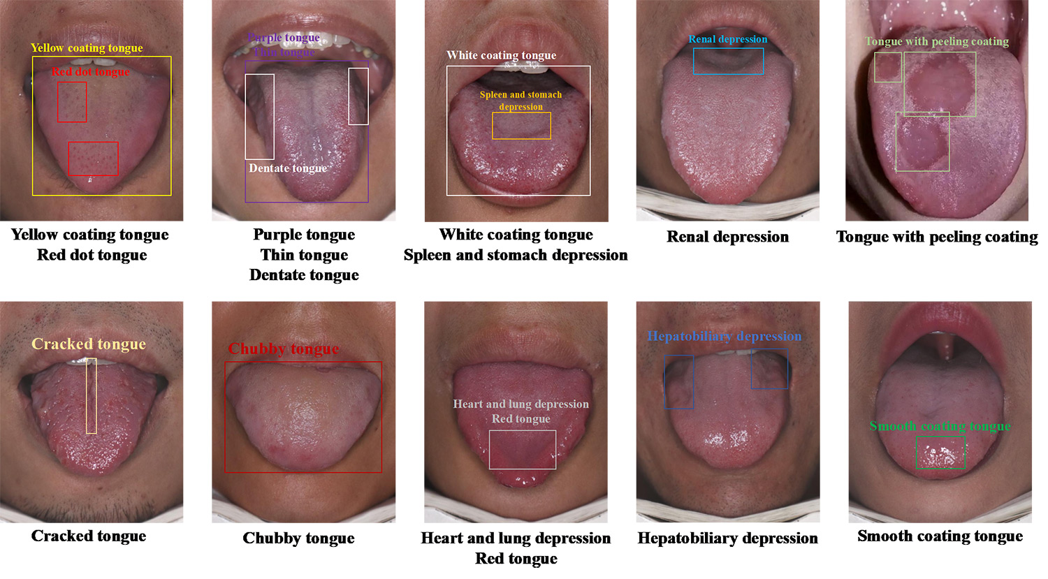 A Tongue Image Dataset with Pathological Annotations for AI-assisted Diagnosis in Traditional Chinese Medicine