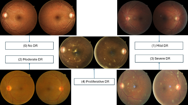 Diabetic Retinopathy Detection and Analysis with Convolutional Neural Networks and Vision Transformer